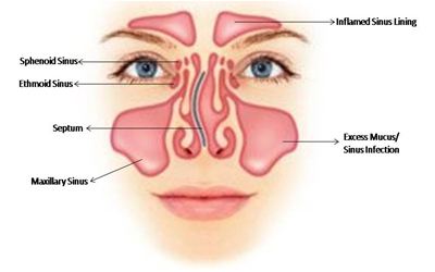 sinusitis